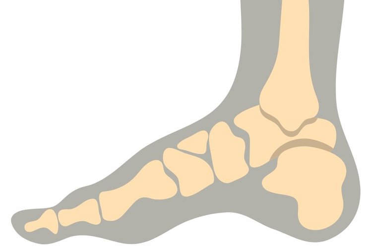 True to its name, also known as Cavus Foot, a high arched foot means your foot has a very high arch that is higher than that of the average person. This type of foot is quite common with many people around the world, it can happen at different ages. A person may have one or both feet with high arches. Due to the unusual structure of the high arched foot, bodyweight is more focused on the heel and ball of the foot than the normal foot. That leads to many symptoms such as foot pain, instability or imbalance.