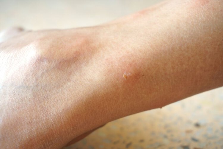 beg bug bites on a leg